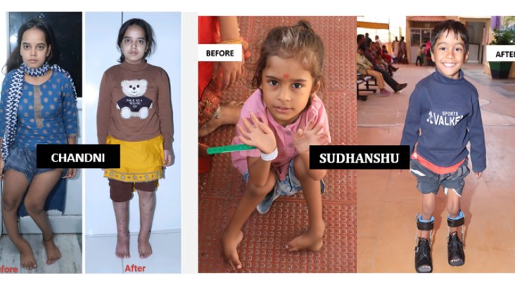 Narayan Seva Sansthan Provides Free Surgeries and Rehabilitation for Persons with Disabilities